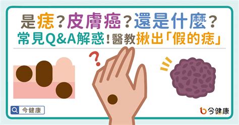 為什麼會長黑痣|是痣？皮膚癌？還是什麼？常見Q&A解惑！醫教揪出「。